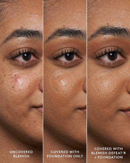 Close-up of model's medium-toned face showing an uncovered blemish, a foundation-covered blemish and a foundation and Blemish Defeat'r BHA Spot-Targeting Gel-covered blemish.